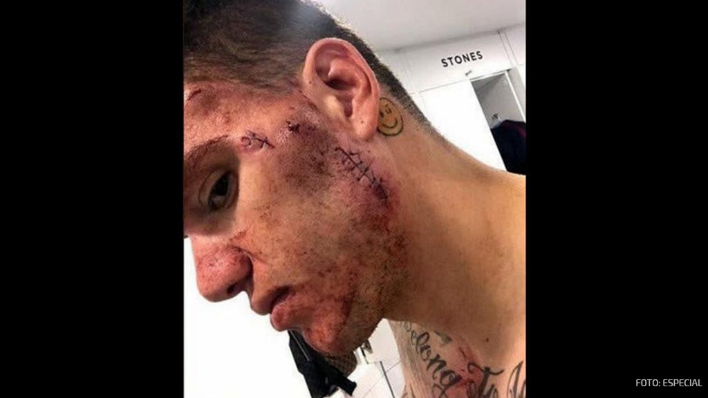 Portero de Manchester City muestra herida tras brutal patada 0